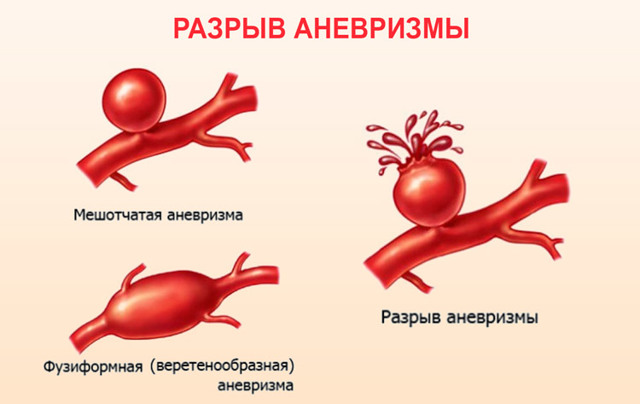 Расширение восходящего отдела аорты сердца