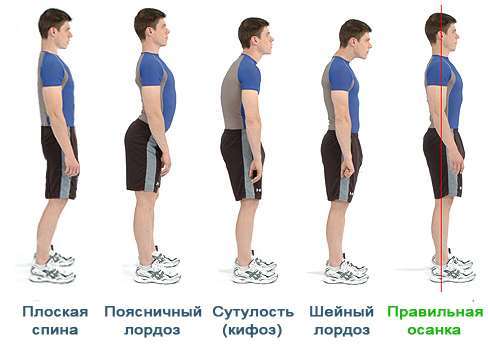 Лордоз – что это такое, как лечить и предупредить