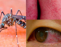 Вирус Зика - причины, симптомы и лечение Zika virus
