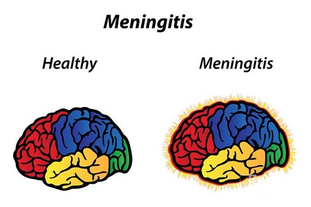 Менингит — симптомы, лечение и последствия