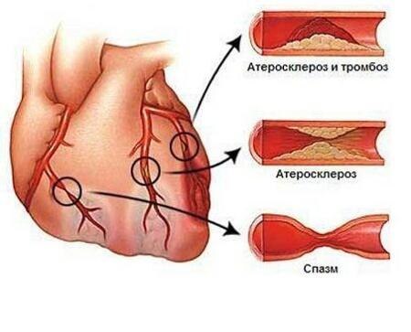 Стенокардия - симптомы и явные признаки приступа у женщин и мужчин