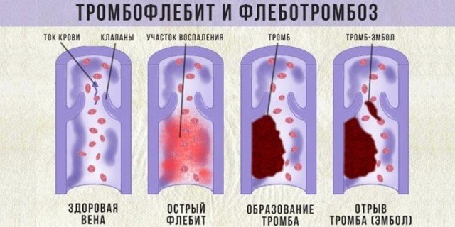 Флебит - что это такое, причины, симптомы, лечение