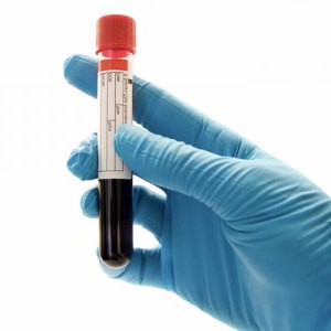 Что означает pdw в анализе крови и методы расшифровки