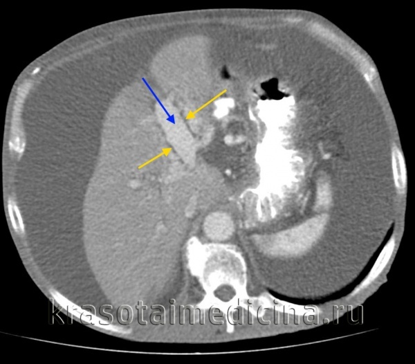 Билиарная гипертензия печени: симптомы, признаки на УЗИ и лечение синдрома