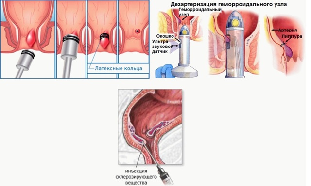 Что такое лигирование внутреннего геморроидального узла — Сайт о геморрое