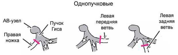 Блокада левой ножки пучка Гиса на ЭКГ (полная и неполная)