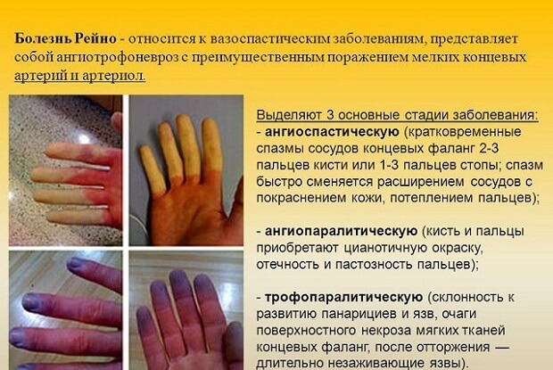 Болезнь Рейно – симптомы у женщин. Болезнь и синдром Рейно – причины, диагностика, лечение, прогноз
