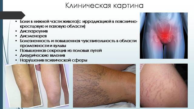 Варикоз вен малого таза у женщин: фото, симптомы и лечение