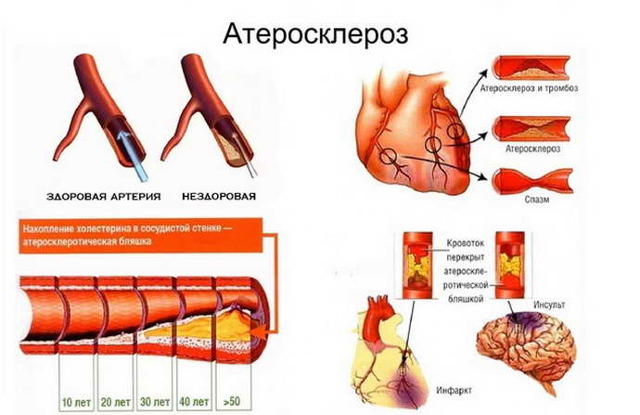 Что такое Острое нарушение мозгового кровообращения?