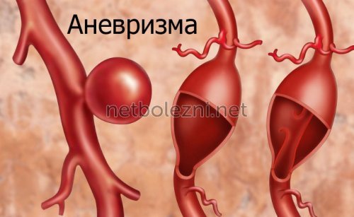 Альфа-амилаза в крови повышена