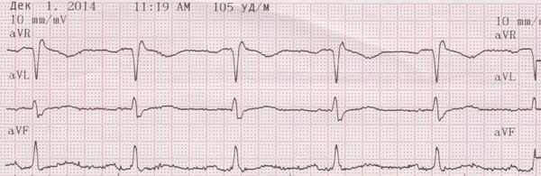 Дисметаболическая кардиомиопатия: симптомы и лечение