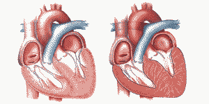 Дисметаболическая кардиомиопатия: симптомы и лечение
