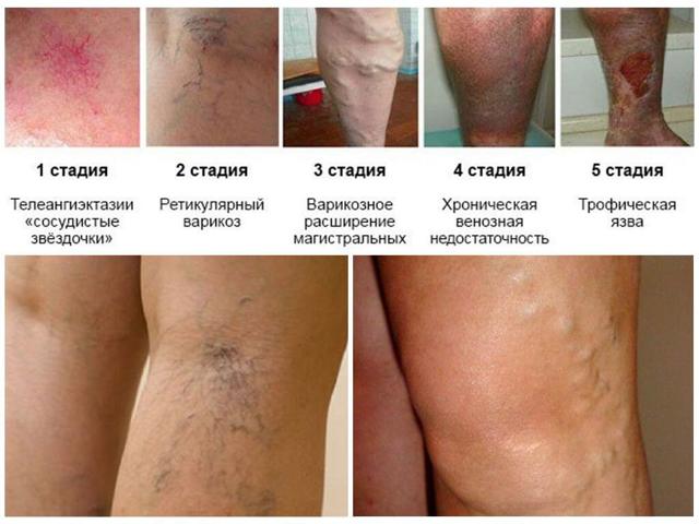 Внутренний варикоз на ногах (скрытый): симптомы и лечение