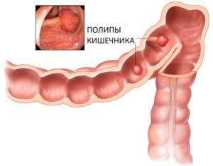 Причины кровотечения из заднего прохода. Что делать, последствия