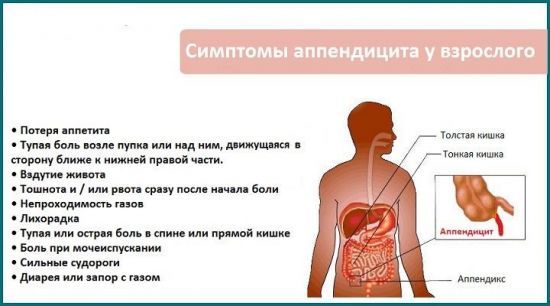 Острый аппендицит у взрослых