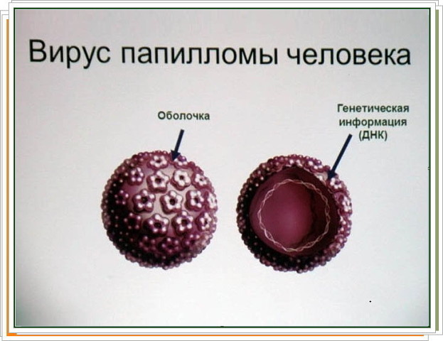 Остроконечные кондиломы у женщин и мужчин: лечение, удаление, причины