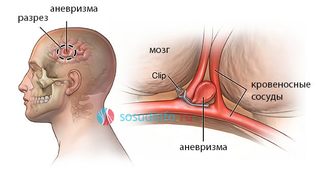 Клипирование аневризмы артерий головного мозга