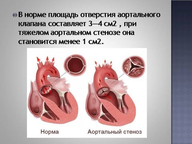 Аортальный стеноз лечение — Сердце
