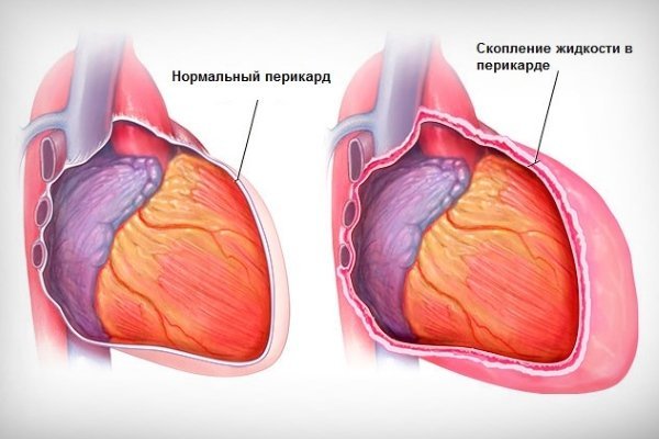 Хронический перикардит, симптомы хронического перикардита