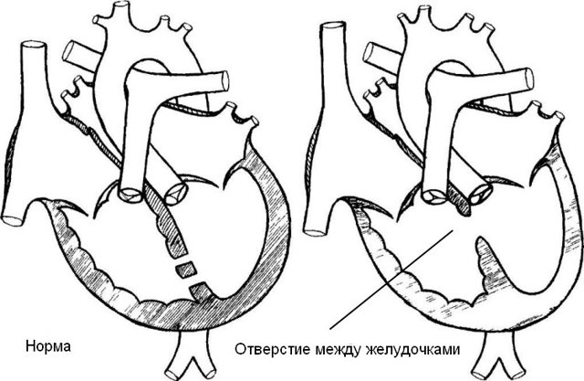 Дефект межжелудочковой перегородки сердца у новорожденных детей
