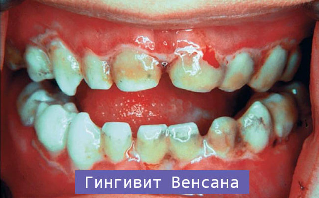 Острый, язвенно-некротический гингивит Венсана: лечение, симптомы и диагностика