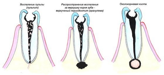 Киста зуба — причины, признаки и симптомы, лечение