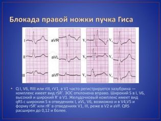 Неполная блокада правой ножки пучка Гиса
