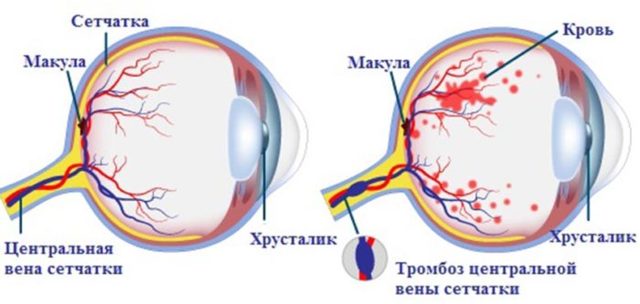 Инсульт глаза симптомы
