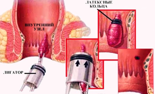 Геморрой при беременности - признаки, симптомы, причины и лечение