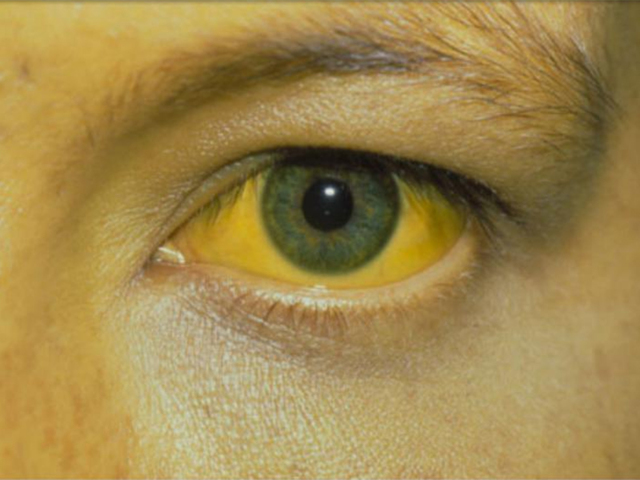 Викасол - таблетки и ампулы: цена и инструкция по применению лекарства