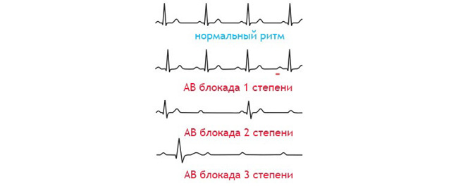 Картинки ЭКГ при нарушениях ритма