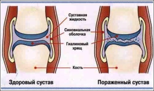 Сосудорасширяющие препараты при артрозе применение