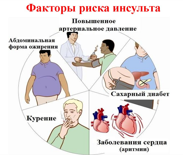 Причины инсульта и как он возникает. Знать всем!