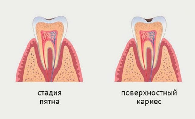 Поверхностный кариес - причины, симптомы и лечение