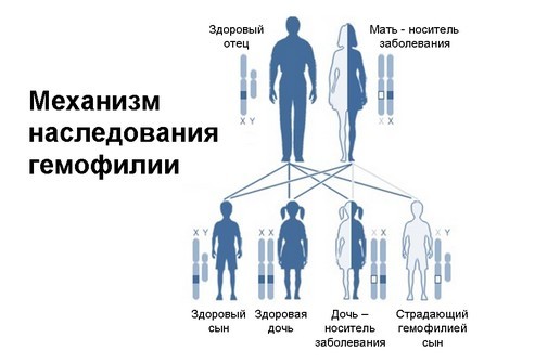 Гемофилия: ген, признаки и лечение. Гемофилия у детей и взрослых.