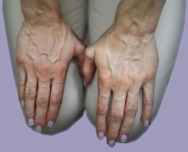 Выступают вены на руках у женщин и мужчин: причины, лечение сильно выпирающих вен