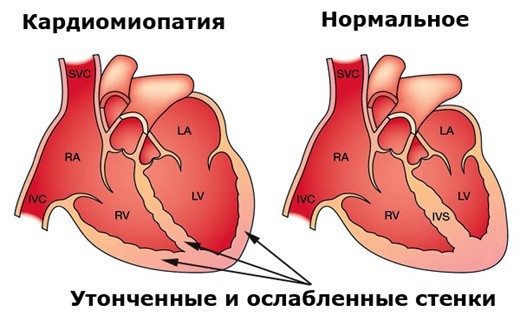Кардиопатия сердца: симптомы, диагностика и лечение. Что такое кардиопатия у детей? Кардиопатия у детей и взрослых: причины, симптомы, лечение и возможные последствия.