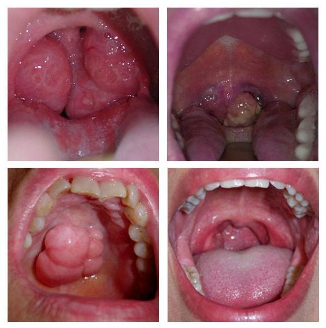 Рак гортани: Признаки, Причины, Симптомы рак горла, Лечение