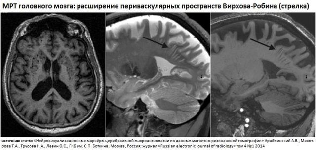 Единичные очаги в белом веществе головного мозга - результаты МРТ
