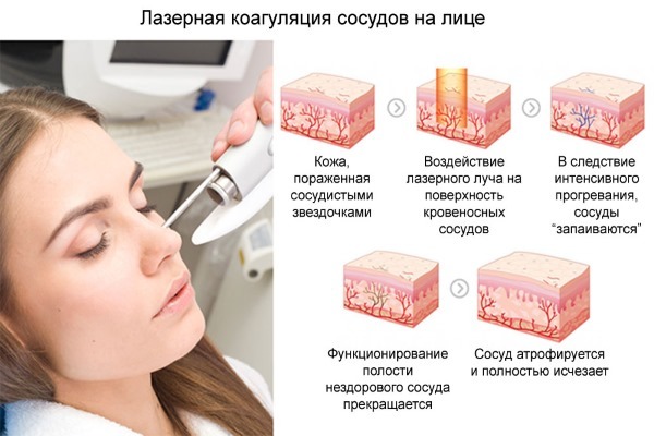 Как удалить сосудистые звездочки на лице? Узнайте о достижениях современной медицины.