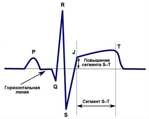 Позиция сердца вертикальная: как выглядит, признаки заболевания, расшифровка, что это