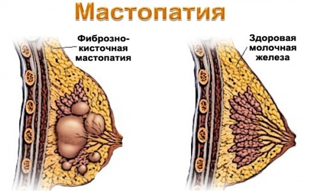 Боль в правой груди: что это может означать
