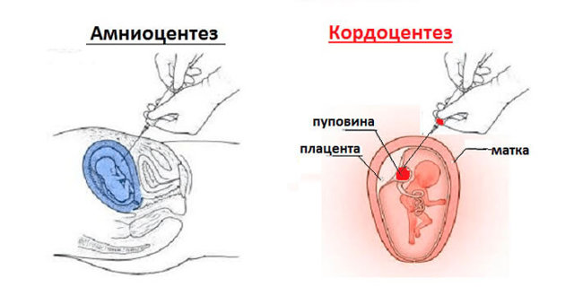 Резус конфликт при беременности: последствия для ребенка