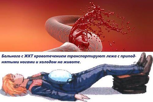 Желудочно-кишечное кровотечение: симптомы, неотложная помощь. Неотложная помощь желудочно-кишечного кровотечения