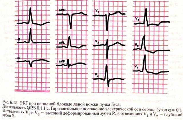 Блокада левой ножки пучка гиса на экг — Сердце