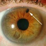 При сахарном диабете упало зрение что делать — Диабет и всё о нём