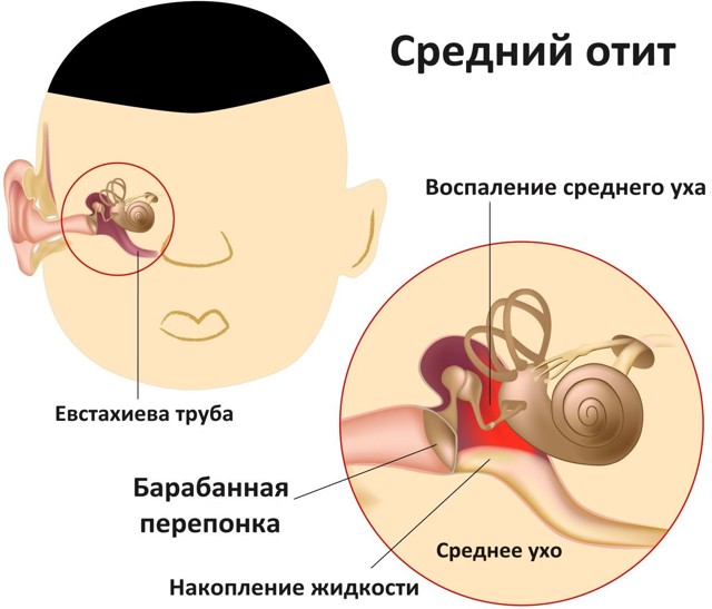 Кровь из уха при отите – причины и лечение 2019