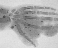 Флеболиты в малом тазу у мужчин - Все про холестерин