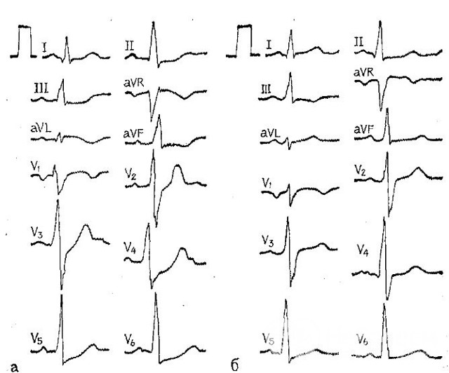 От чего происходит инфаркт миокарда