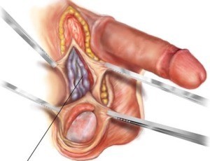 Видео операции варикоцеле яичка: процесс и исход